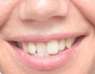 ارتودنسی یک دندان کج