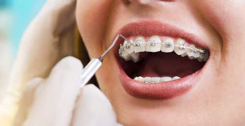 ارتودنسی دندان نیش