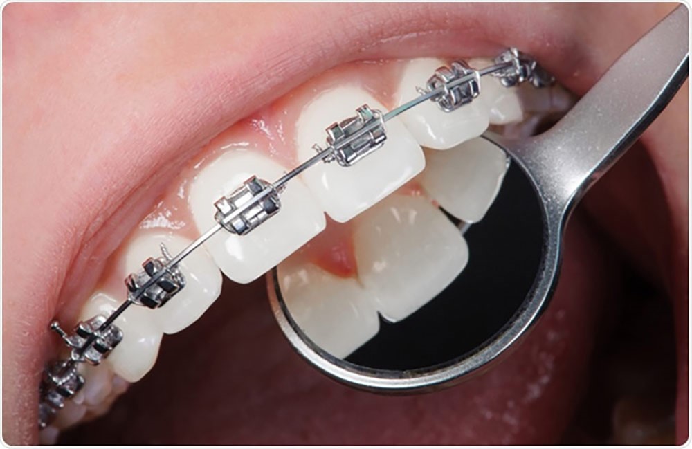 ارتودنسی دندان چه عوارضی دارد
