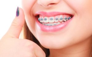ارتودنسی دندان چه عوارضی دارد
