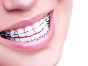 ارتودنسی یک دندان کج