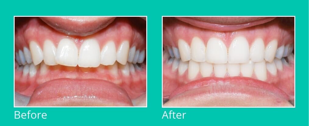 ارتودنسی دندان قبل و بعد