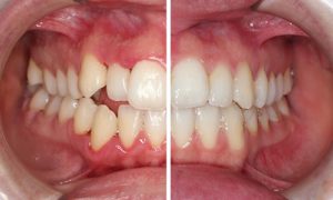 ارتودنسی دندان قبل و بعد 