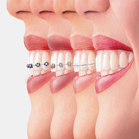 ارتودنسی دندان چند مرحله دارد