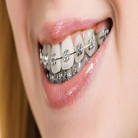  ارتودنسی دندان تاچه مدت طول میکشد