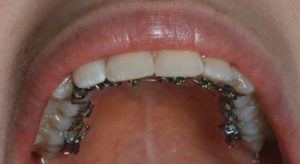 ارتودنسی دندان از داخل