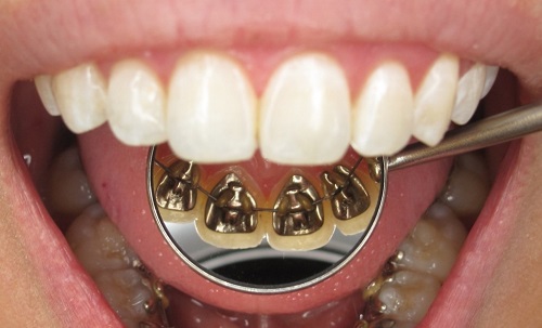 ارتودنسی دندان از داخل
