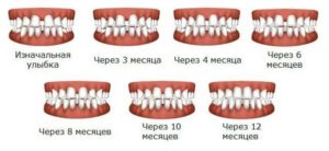 ارتودنسی و تغییر چهره-2