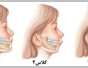 ارتودنسی جراحی فک پایین-1