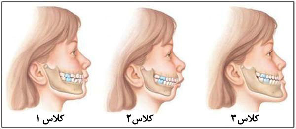 ارتودنسی جراحی فک پایین-1