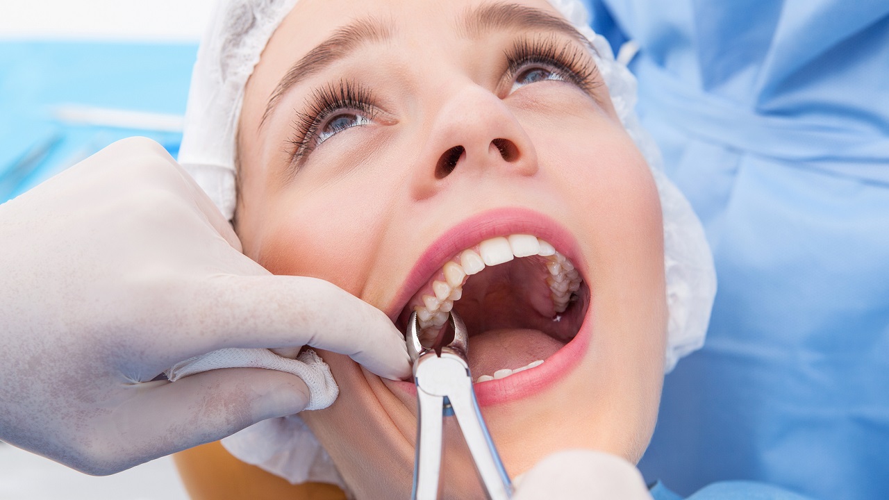 کشیدن دندان عقل قبل از ارتودنسی دندان
