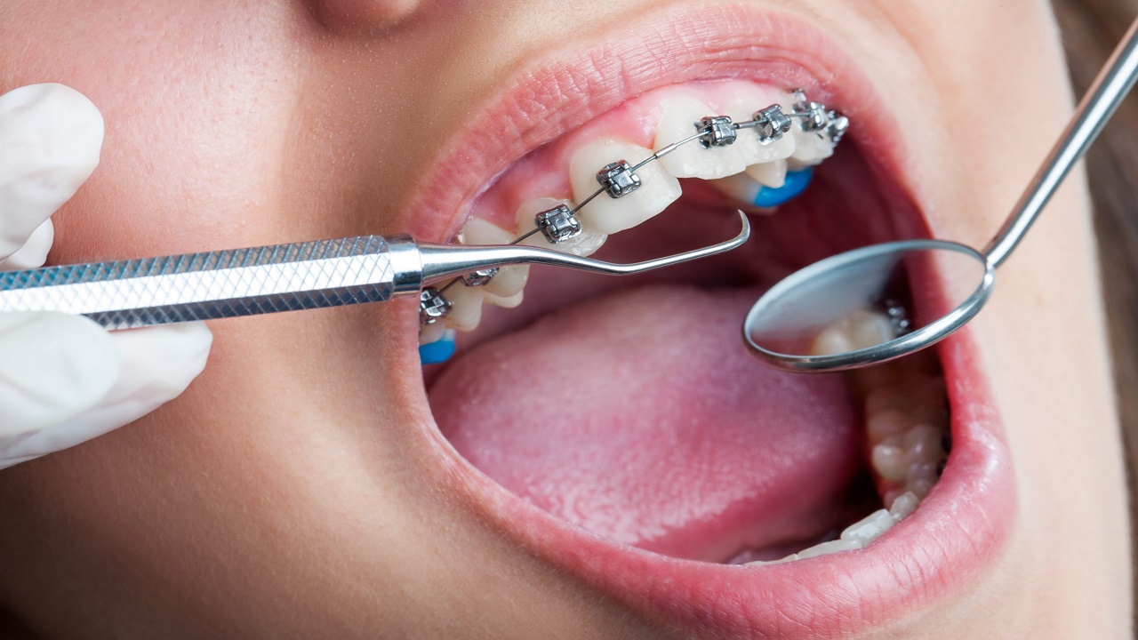 چکاپ ارتودنسی دندان