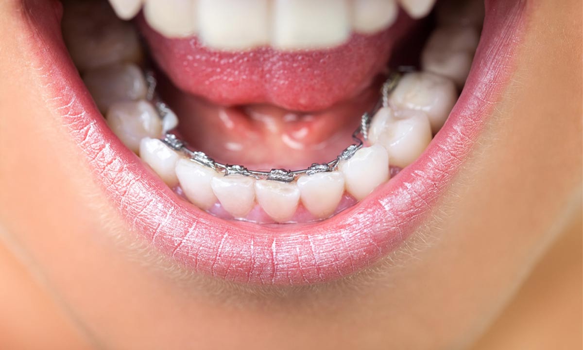 دندانهای ارتودنسی شده با ارتودنسی لینگوال
